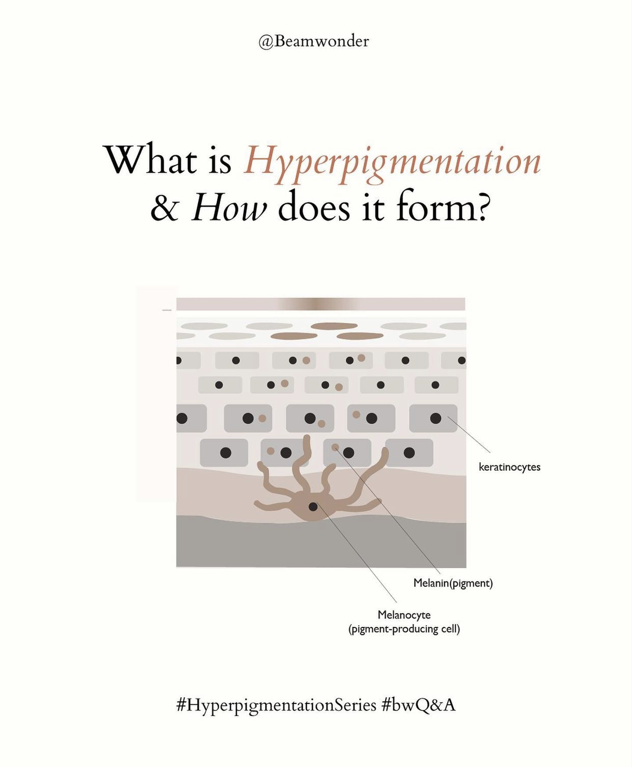 What is Hyperpigmentation?